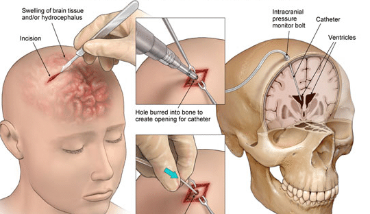 an-overview-of-ventriculostomy-neurosurgical-procedure-an-evd-placement-task-is-also.png