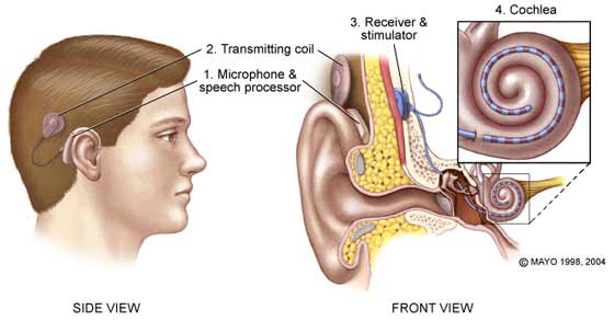 cochlearimplant.jpg