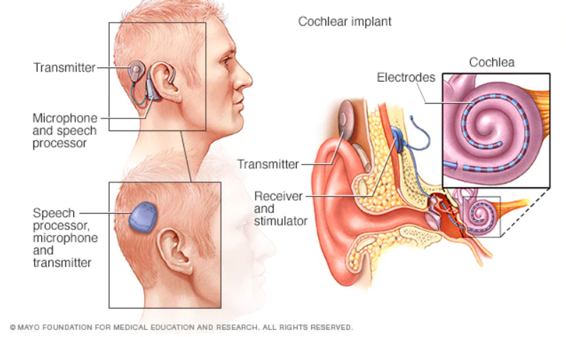 cochlear_implant.png