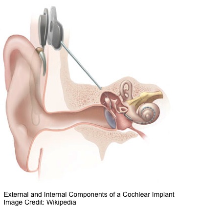 cochlear_implant_captioned_.jpg