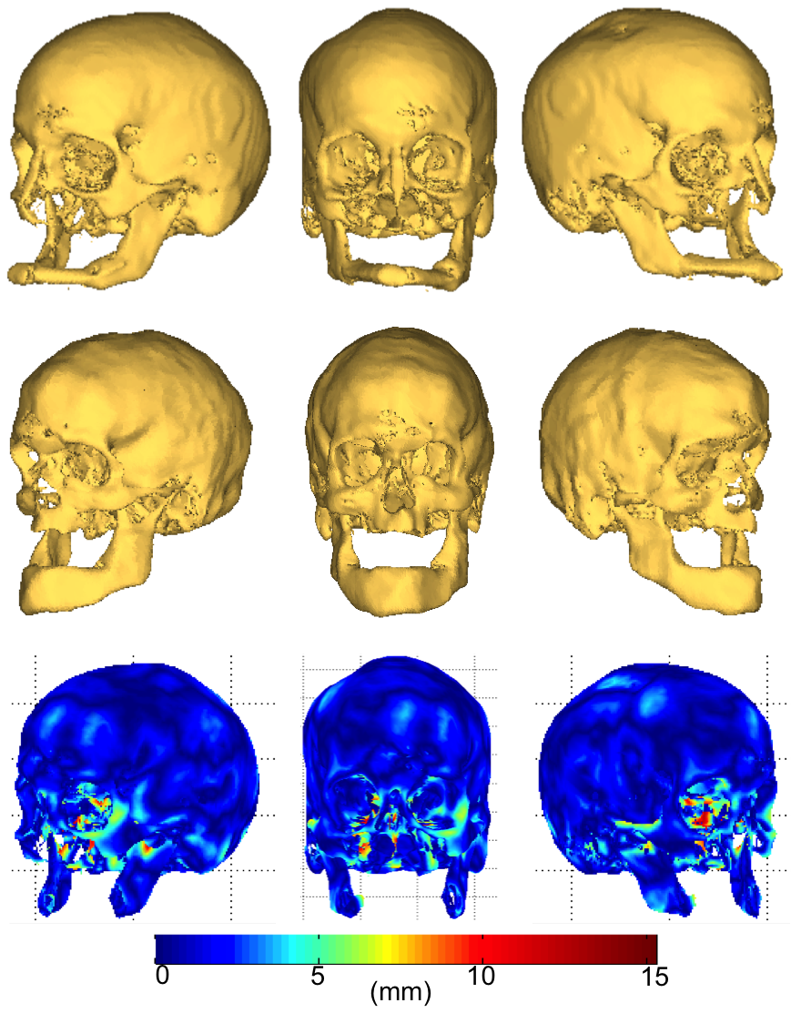 Figure 6: A craniofacial transplant candidate. Top: current skeletal structure. Middle: Atlas reconstruction. Bottom: Heat map of residual surface errors in normal regions