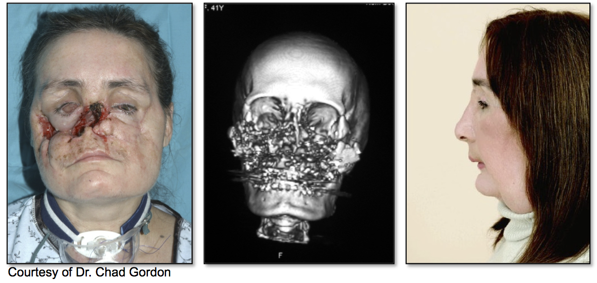 Figure 2: A craniofacial transplant recipient. Left preoperative photograph, middle preop- erative CT, right postoperative photograph.