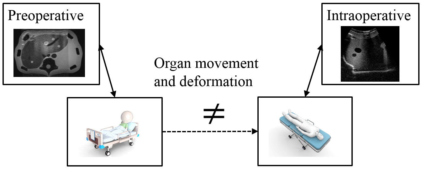 Due to deformations and organ movement, the patient's current anatomy differs from the preoperative image