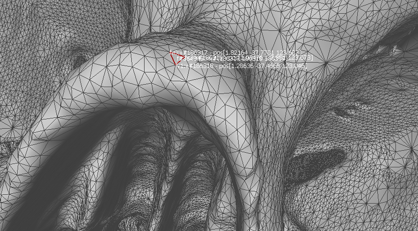  Temporal bone tip target coordinate