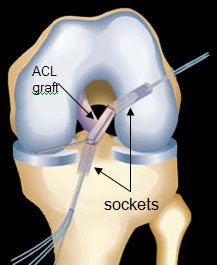 ACL surgery (http://goortho.net/images2/acl-knee-surgery.jpg)