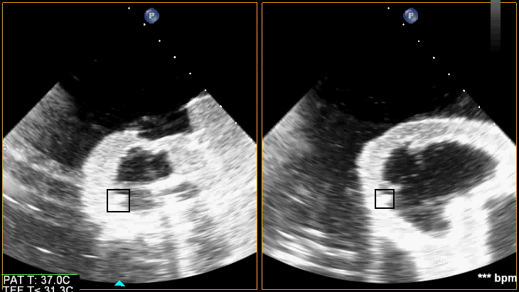 Figure 3. Ultrasound images showing the foreign body (outlined) in the heart phantom in two orthogonal slices, and in 3D.