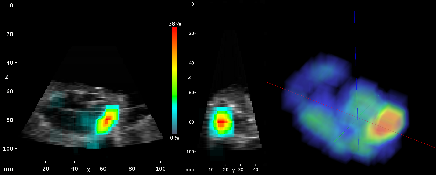 Figure 7. Probability map of the foreign body position. Left and center: Coronal and sagittal slices. Right: 3D view.